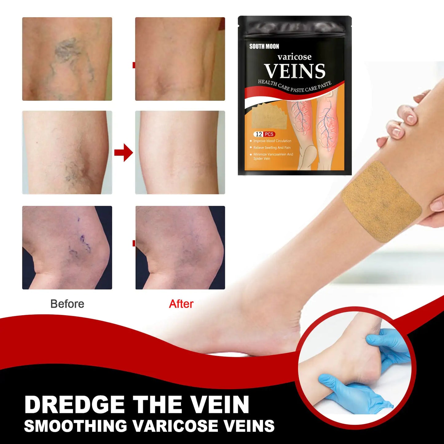 Relief Patches For Varicose Spider Veins